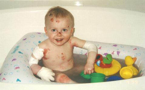 Nicky in the bath at 26 months old. He cannot be completely naked due to the fragility of his skin.